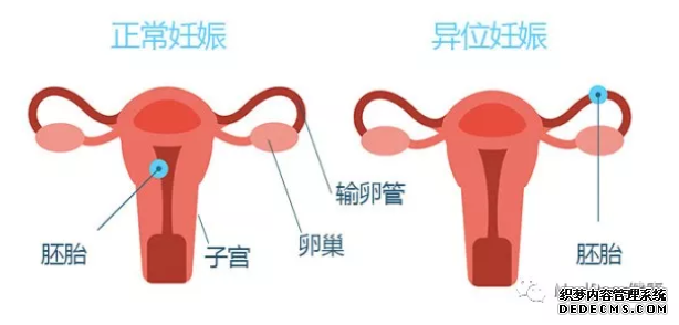 马鞍山当涂县确诊宫外孕需做哪些检查