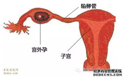 马鞍山当涂县宫外孕的早期症状有哪些