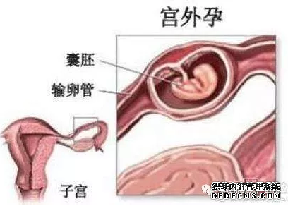 马鞍山当涂县宫外孕要开刀手术吗