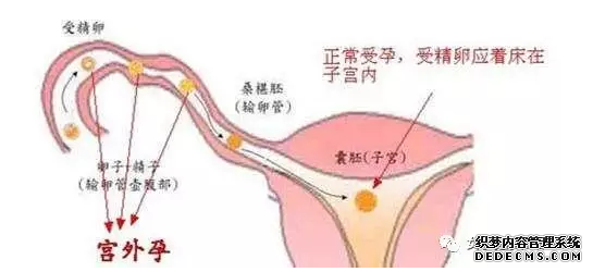 马鞍山含山县患了宫外孕如何治疗比较好？